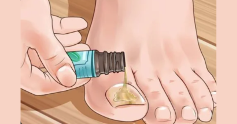 Mikoherb gel za gljivice na noktima i stopalima